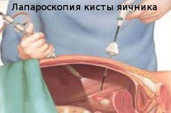 Как в домашних условиях избавиться от кисты яичника Как в домашних условиях избавиться от кисты
